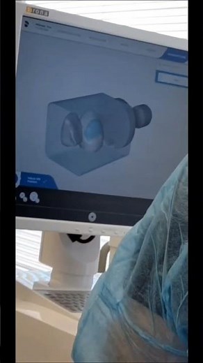 Designing a cantilever bridge #dental #cerec #cantileverbridge #finishedproduct