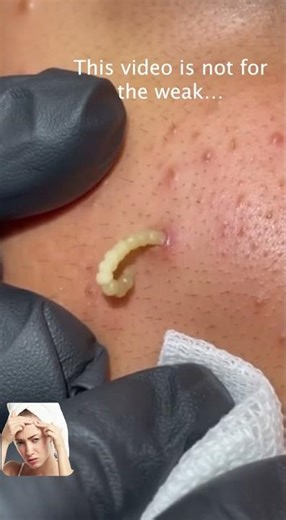 Pus volcano on the face 🌋