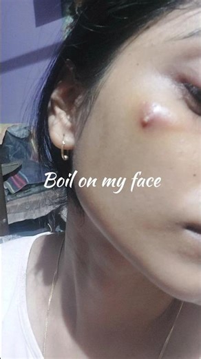 Breakout on My Skin / boil gone using home made face mask #shorts #ytshort #skincare #pimplefreeskin