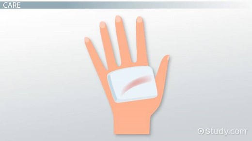 Granulating Wound Stages | Definition & Types