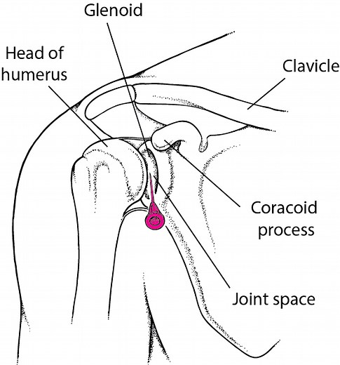 How To Do Shoulder Arthrocentesis - Musculoskeletal and Connective Tissue Disorders - MSD Manual Professional Edition