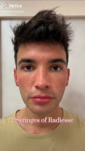 Jawline Fillers: Techniques and Results Explained