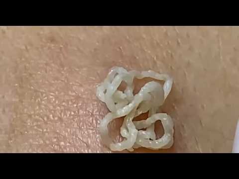 The Most Satisfying Deep Blackhead Extractions Ever! 😱 | Pimple Popper Wow