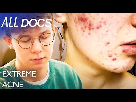 Extreme Acne | S01 E01 | Medical Documentary | All Documentary