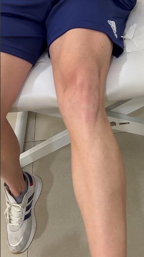 Signo de la J invertida : inestabilidad rotuliana #traumatología #rodilla #exploración
