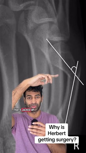 𝗡𝗶𝘁𝗵𝗶𝗻 𝗩 𝗡𝗮𝘁𝘄𝗮 𝗠𝗗 on Instagram: "Justin Herbert update What’s an acceptable fracture angle for a boxers fracture without needing surgery?"