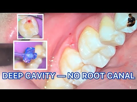 Selective Caries Removal & Direct Pulp Capping Stamp Composite Technique — Step-by-Step Case