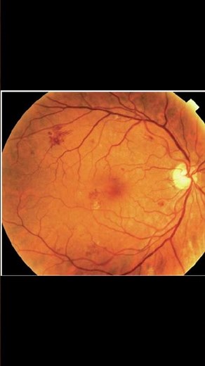 The Four Stages of Diabetic Retinopathy - Mild NPDR
