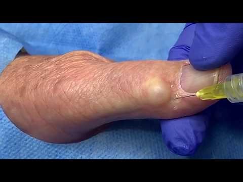 Ganglion Cyst (Jelly Doughnut Hole) Extraction