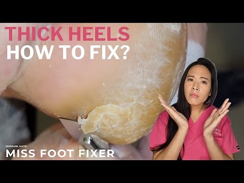 Crack Heels Removal by MissFootFixer