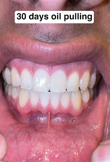 Oil Pulling Results After 30 Days of Use