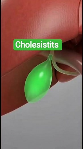 Cholecystitis Explained | Gallstones & Gallbladder Inflammation (3D Animation) #medicalanimation
