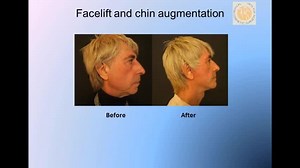 Facelift and chin augmentation