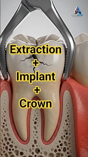 3D animation of a Dental extraction,Implant Installation Crown Placement #DentalImplant#Dentistry#3D