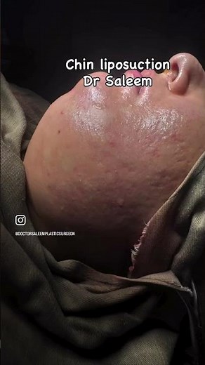 Double chin liposuction before & after