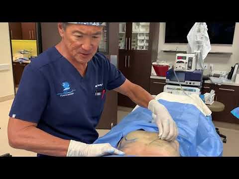 Microcannula Tumescent Liposuction Procedure