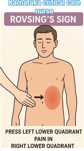 ROVSING'S SIGN 🛑#shortvideo #education #nurse #ytshorts #viral