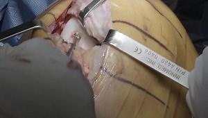 Debriding a Lateral Femoral Condyle Defect
