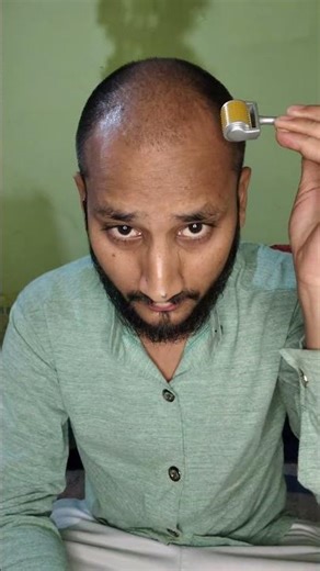 8th week of derma roller | micro needling #shorts #dermaroller #microneedling #hairregrowth #viral