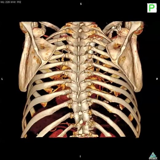 Osirix 3D Rendering Thoracic CT Scan