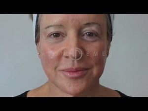 Erbium Laser Skin Resurfacing Treatment | Anti Wrinkle Treatment | Beverley Hills | Dr. Jason Emer