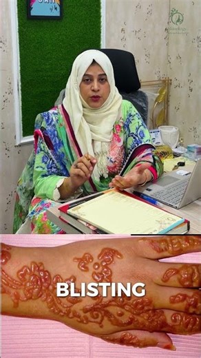 Chemical Mehndi Can Burn Your Skin (Truth You’re Ignoring)
