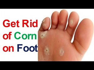 Corn Treatment How to Get Rid of Corn on Foot Corn Removal