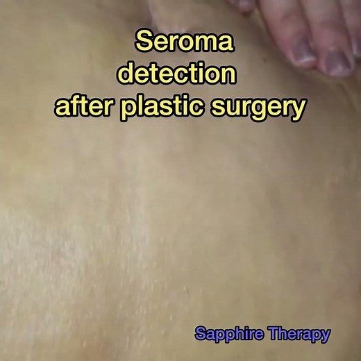 Seroma detection process after plastic surgery.