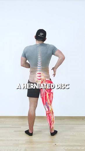 ⚡ What Is A Herniated Disc? 😨 A herniated disc is when the outer layer of your disc, the annulus fibrosus cracks which allows the inner liquid, the nucleus pulposus to protrude outward compressing your spinal nerve roots causing pain, numbness or weakness in your lower back, buttocks or legs. Here are 3 exercises to help alleviate recover your herniated disc and alleviate the pain: 1️⃣ Kneeling pelvic Tilts This will help reduce inflammation around your disc and calm down your nerves. 2️⃣ Rever