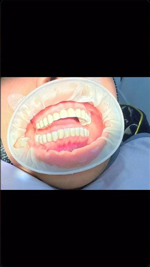 Full Mouth Smile Restoration🦷✨👀