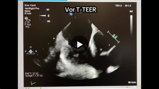 #structuralheart #tteer #tricuspid #pascal #ice #3dice #verisightpro #heartteam #advancedimaging | Michael King