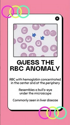 Guess the RBC ANOMALY #5 | Hematology Review
