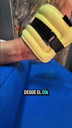 Fractura de tibia y peroné