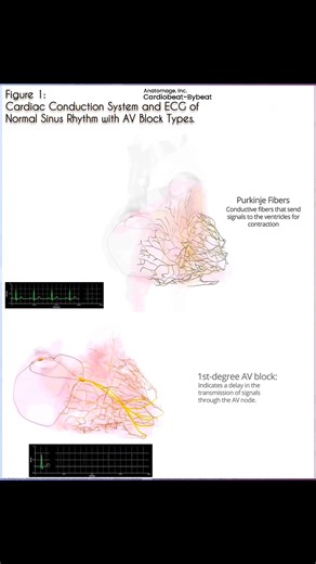 Explore the cardiac conduction system & ECG patterns! Normal sinus rhythm Vs. 1st, 2nd, & 3rd degree AV blocks. Visual by Anatomage, Inc. #Cardiology #MedicalEducation #HeartHealth | Abdallah Othman