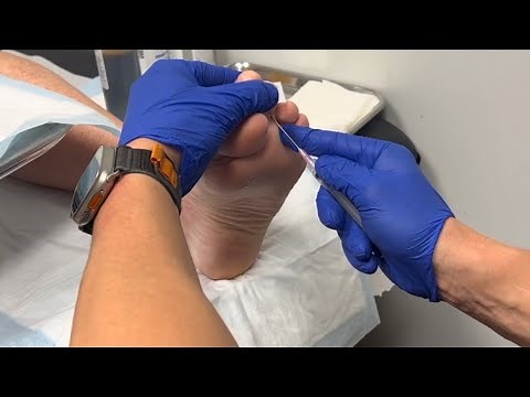 Hammertoe Correction | Flexor Tenotomy: A Satisfying Crunch that’s unexpected 🫠🎧