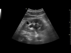 PoCUS Kidney and Bladder Ultrasound