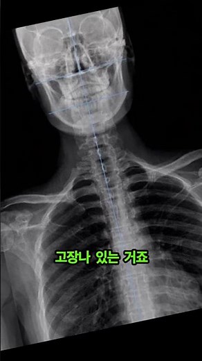 경추 문제를 손가락으로 체크하는 법#경추성두통