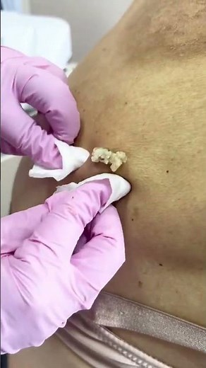 Massive Back Cyst Squeezed Empty — Unbelievable Amount Inside!