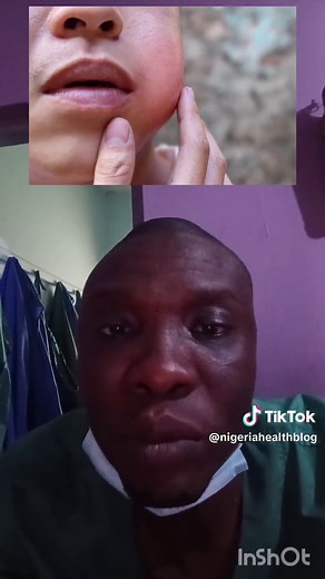 Understanding the Mumps Vaccine for Babies