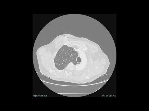 Asvide: CT scan video performed during follow-up period (August 2025). CT, computed tomography.