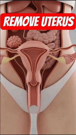Removing the Uterus | Hysterectomy Procedure Explained (3D Medical Animation) #hysterectomy #uterus