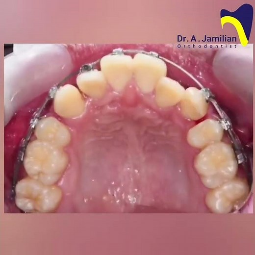 Why Dentists Remove Teeth for Crowding | Premolar Extraction Explained #dentist #brace #orthodontics