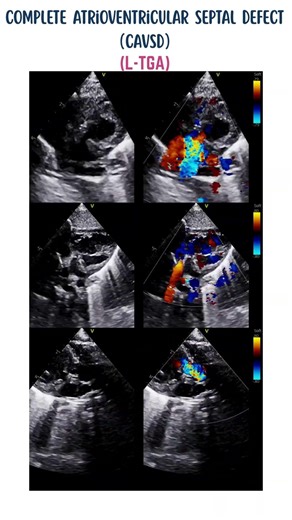 L-TGA with Complete AV Canal Defect (Endocardial Cushion Defect) + Severe Pulmonary Stenosis