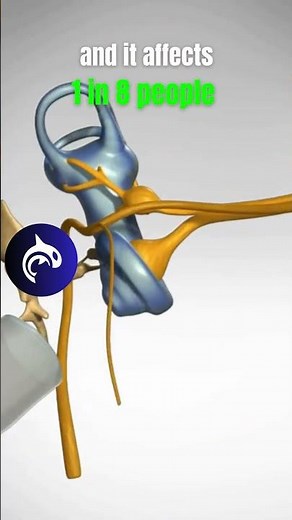 See what Hearing Loss from Nerve Damage looks like in a 4K 3D animation.