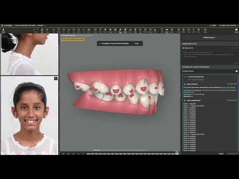 Clincheck Plan Editor + Controles 3D com INTELIGÊNCIA ARTIFICIAL