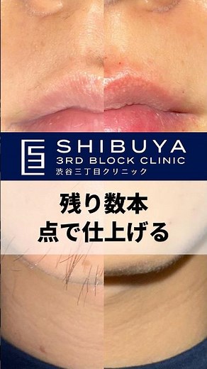 [For those who can't lose just a few hairs] Eliminate them one by one with needle hair removal! #...