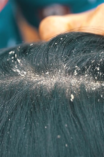 Extreme Flake Pick & Scratch | Real Dandruff Removal ASMR 🔍💨 #FlakyScalp #ScalpCheck #ASMRHealing #SatisfyingVideo #HairCare | Franco Barrera