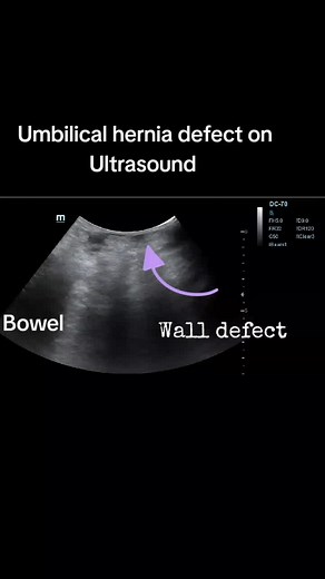 Understanding Umbilical Hernia Revealed by Ultrasound