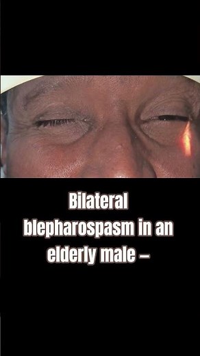 Essential bilateral blepharospasm in an elderly male — a focal dystonia involving orbicularis oculi.