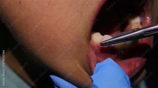 Pediatric dentist removing a primary tooth. Shows child reaction, dental care, oral health, and medical procedure. Ideal for healthcare marketing, dentistry education, and medical awareness content.
